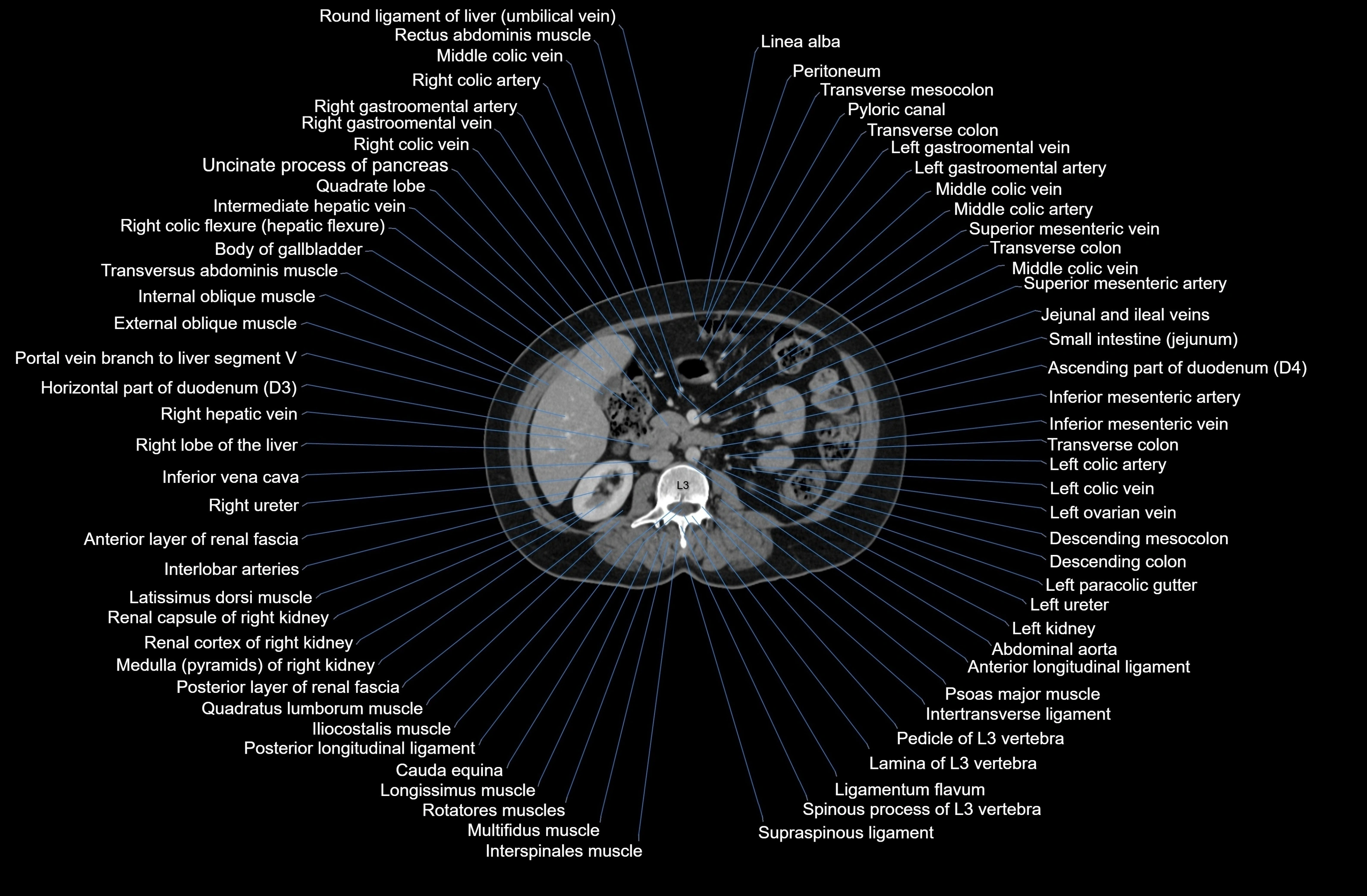 CT Abdomen axial cross sectional anatomy labelled radiology image-00043.webp
